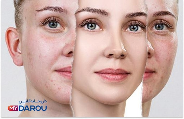 بهترین کرم های ضد جوش